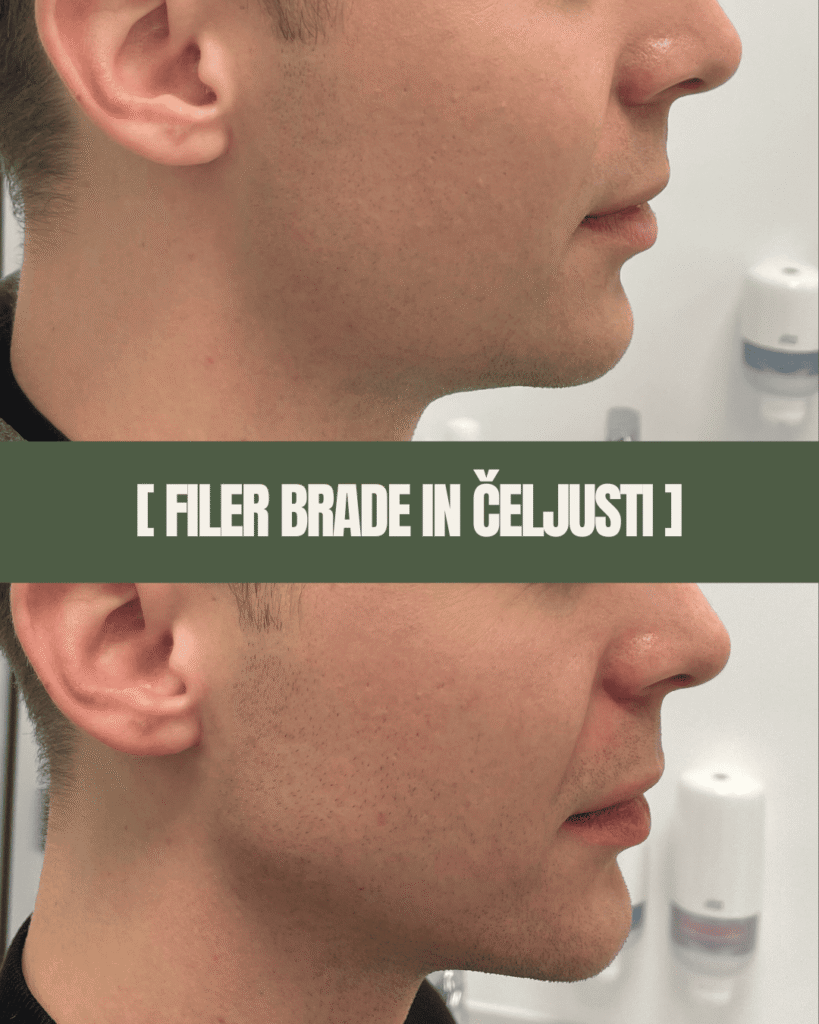 1point6_filler_polnilo_brada_in_čeljust