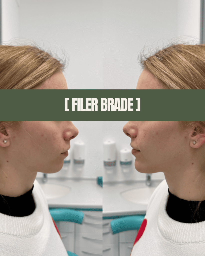 1point6_filler_polnilo_filler_brade
