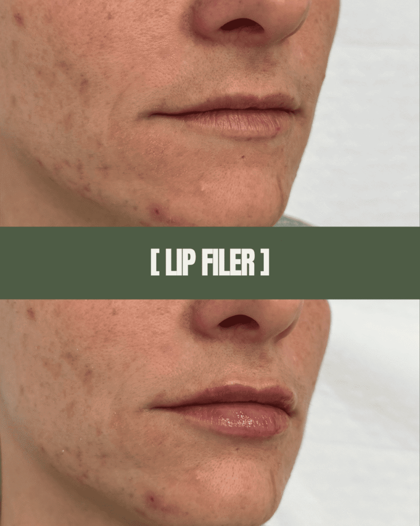 1point6_filler_polnilo_lip_filler