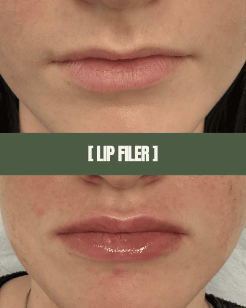 1point6_filler_polnilo_ustnice_1