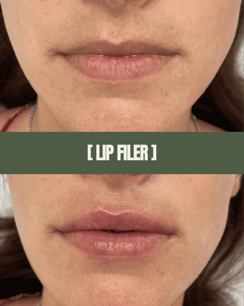 1point6_filler_polnilo_ustnice_2