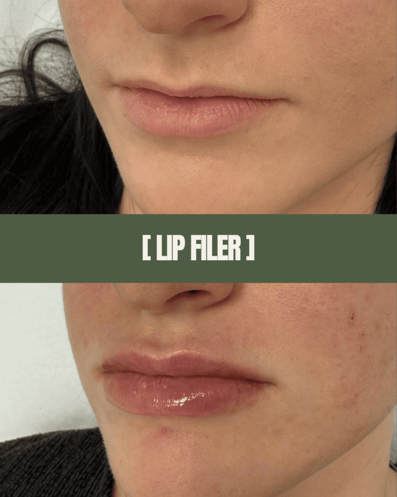 1point6_filler_polnilo_ustnice_3