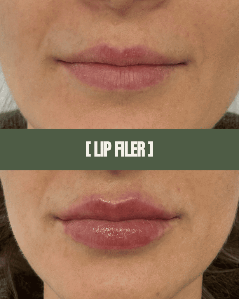 1point6_filler_polnilo_ustnice_4