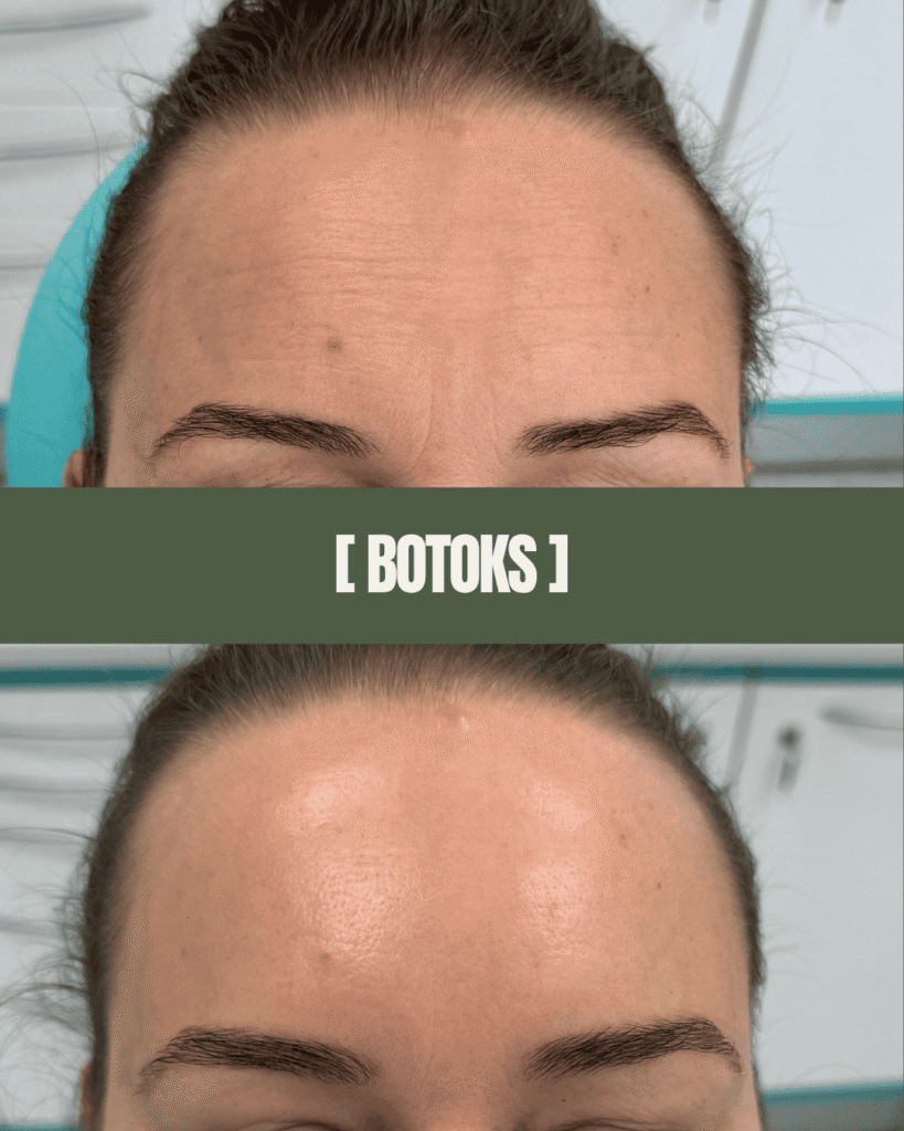 1point6_lip_flip_botox