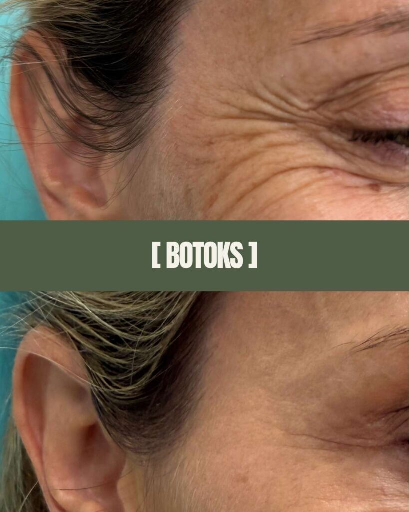 1point6 botoks (2)